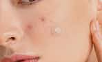 a woman with a pimple patch on her face