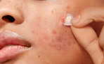 a person taking off an acne patch