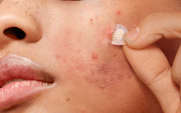 a person taking off an acne patch
