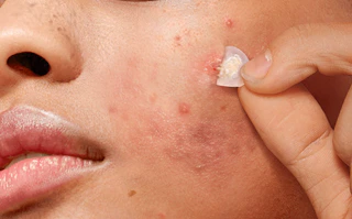 a person taking off an acne patch