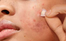 a person taking off an acne patch