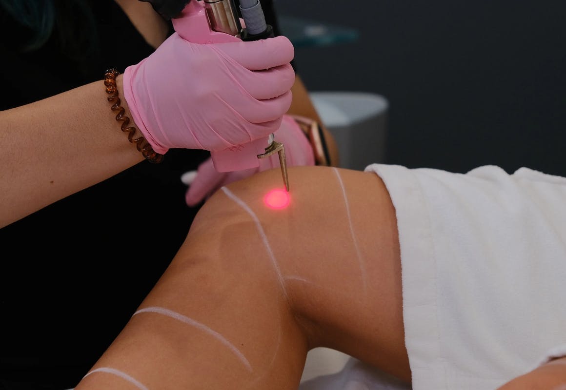 LaserAway Free Consultation
