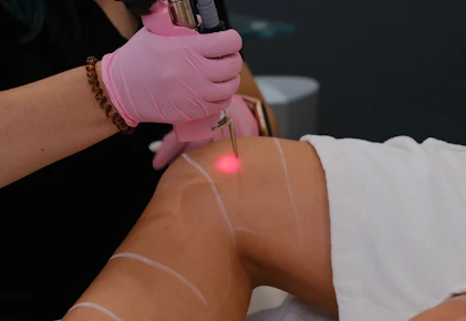 LaserAway Free Consultation