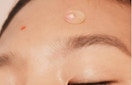 a pimple patch on a person's face